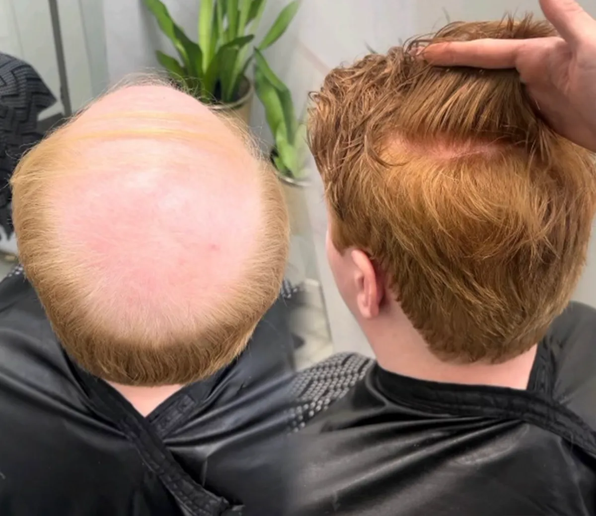 Cincinnati Hair Loss Solutions 