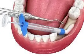 “Bone grafting material used during a dental procedure”