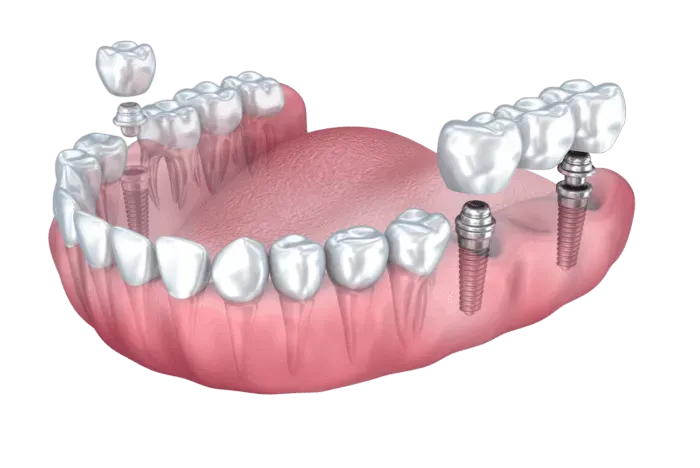 Multiple Dental Implants
