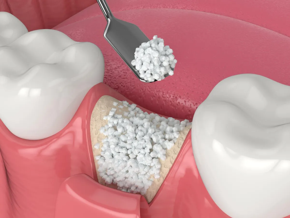 Bone Grafting in Albuquerque, NM