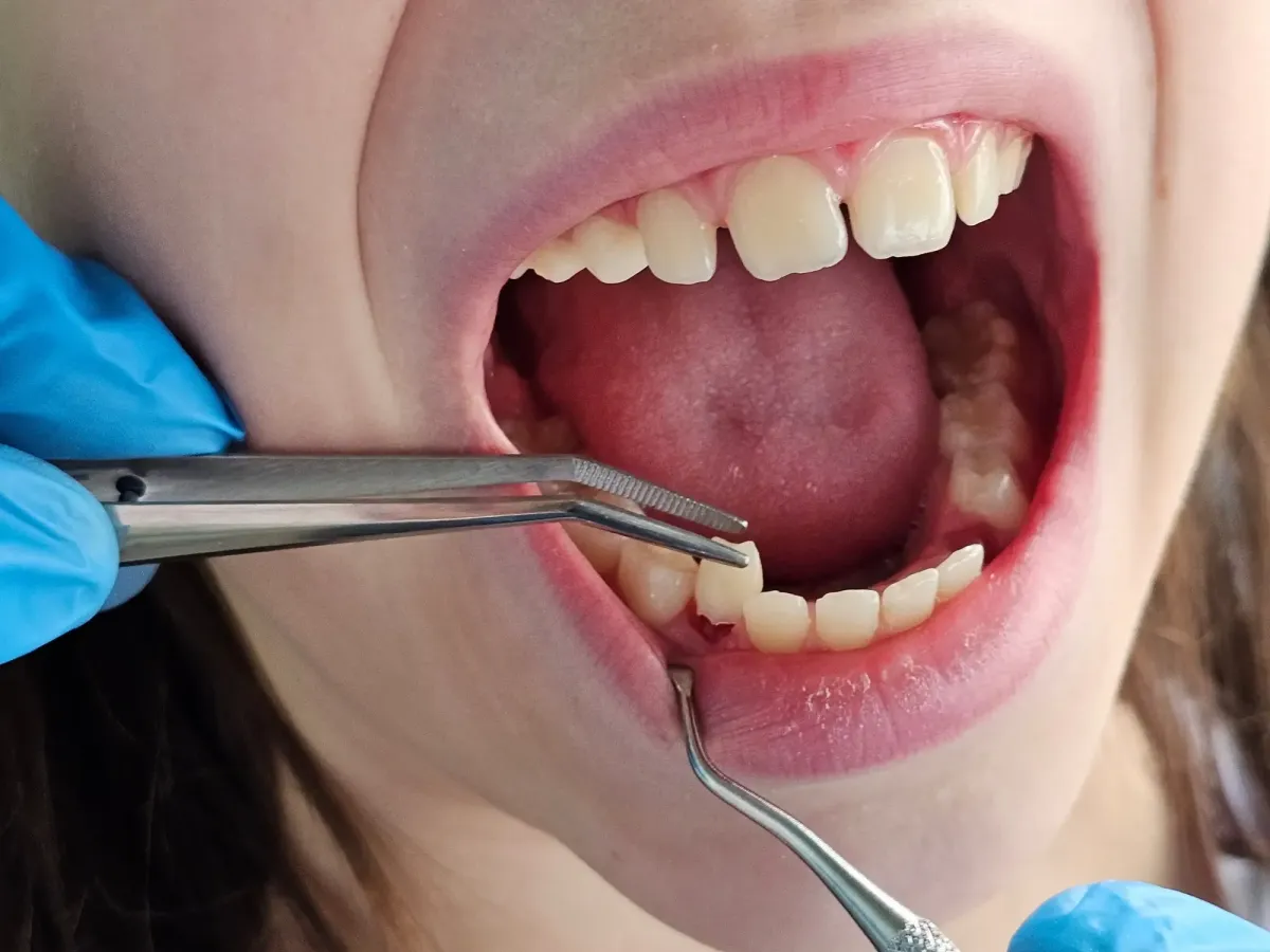 Custom dental implant crown designed for a missing tooth