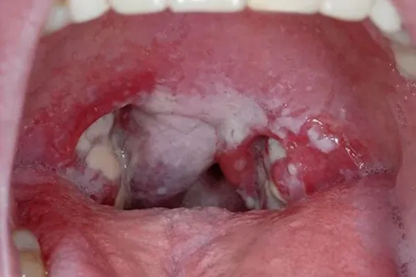 How long does strep throat last in kids, a guide from PediSTAT Urgent Care in Webster, TX How long does strep throat last in kids, a guide from PediSTAT Urgent Care in Webster, TX