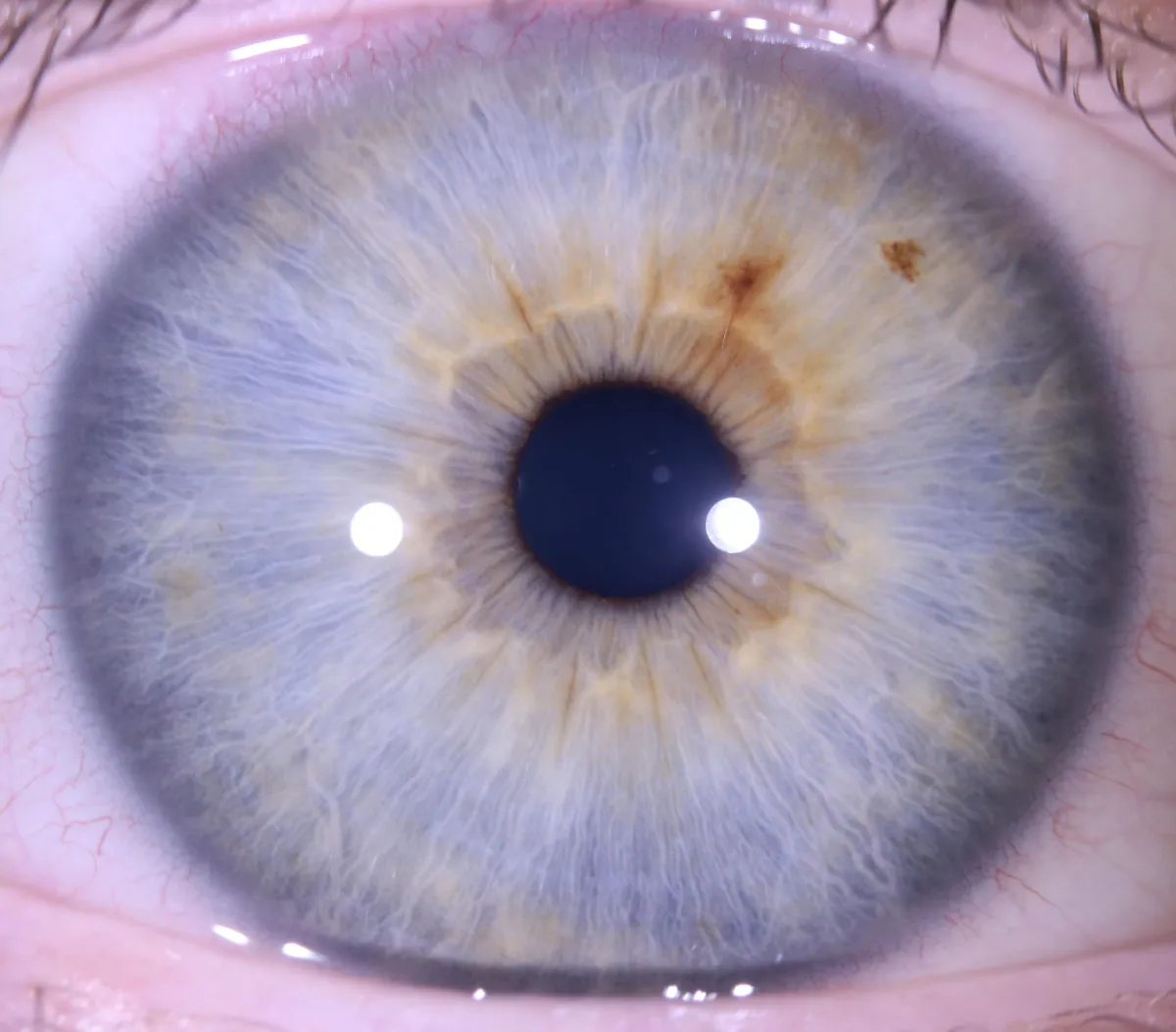blue (lymphatic) iris with transversals