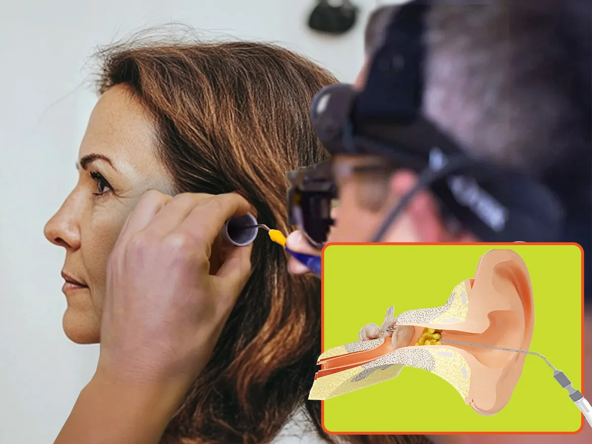 What is microsuction earwax removal?