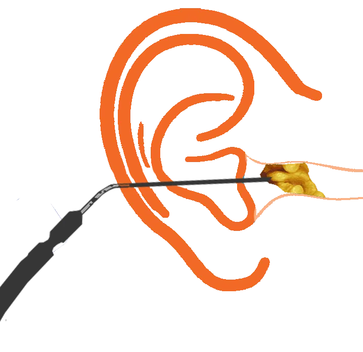 microsuction earwax removal