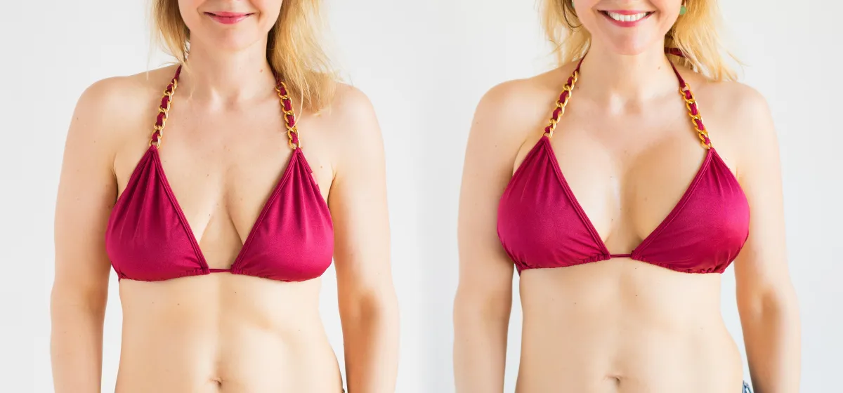 breast augmentation before and after