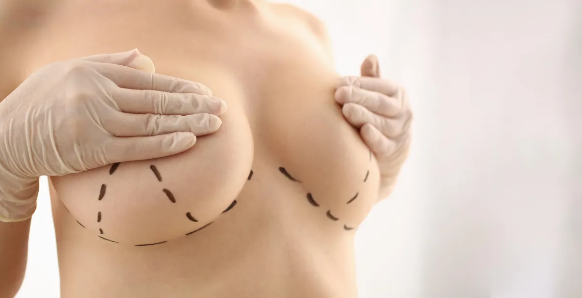 Natural Looking Breast Augmentation in Burlingon