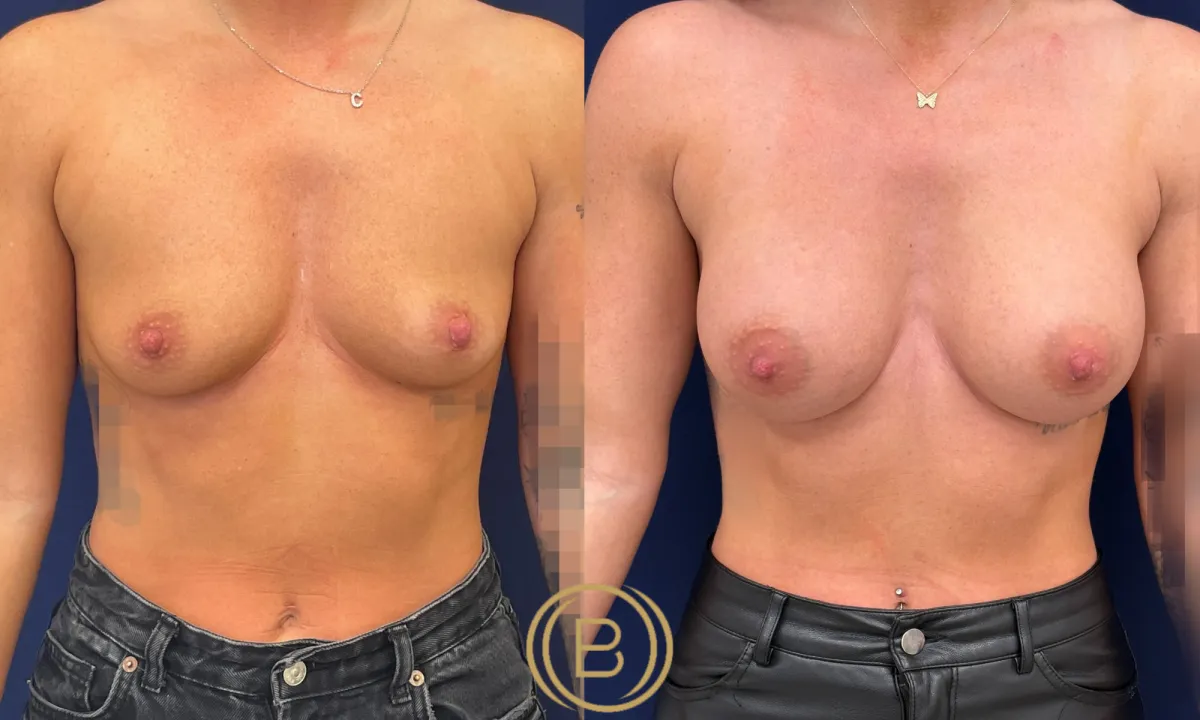 Breast Augmentation Before & After Menu Image