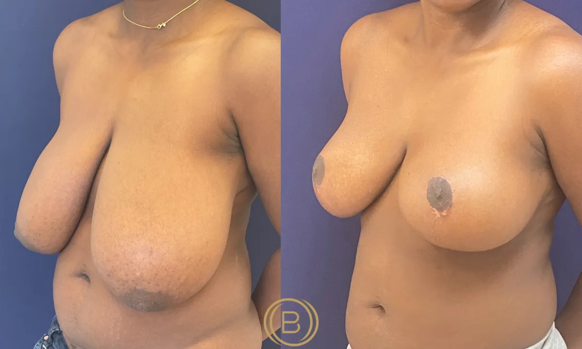 Breast Reduction Menu Option