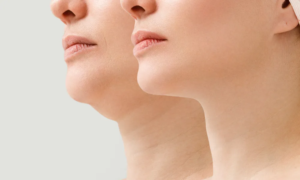 Restore Jawline and Neckline Definition with a Neck Lift in Burlington