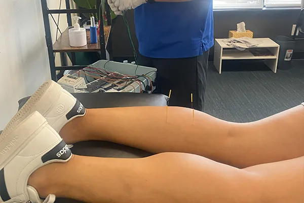 Man receives dry needling from a physical therapist