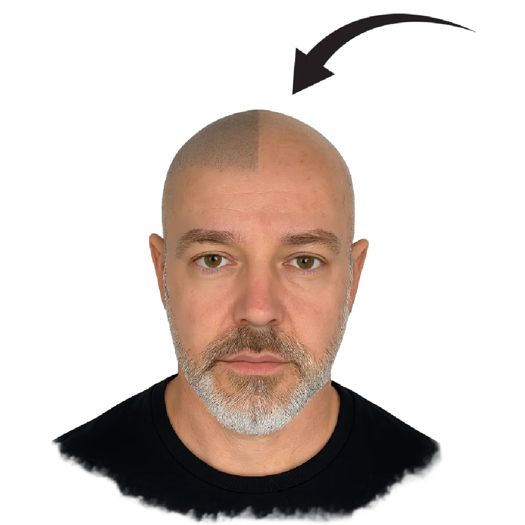 Micropigmentación capilar antes y después