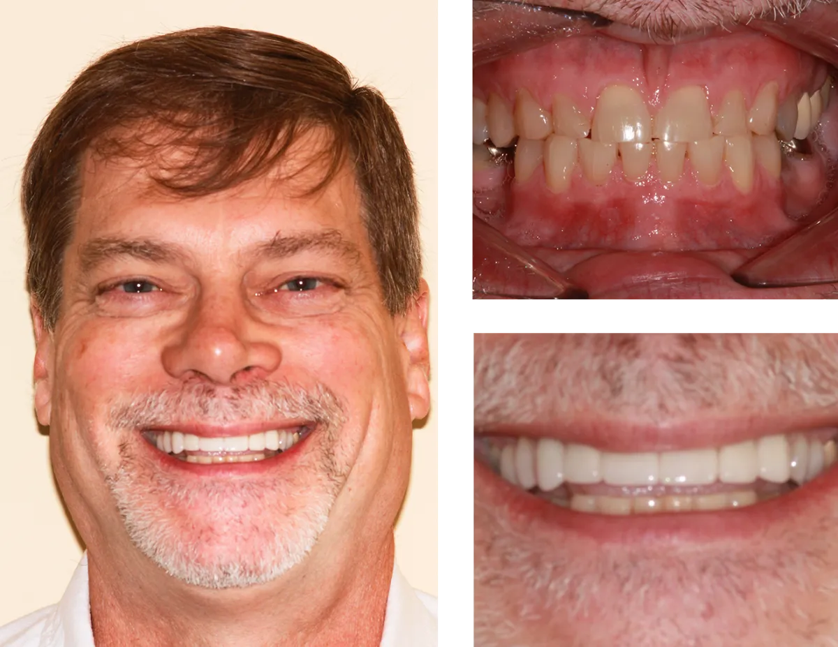 Veneers | dentist paducah ky | Woodyard Dental Care