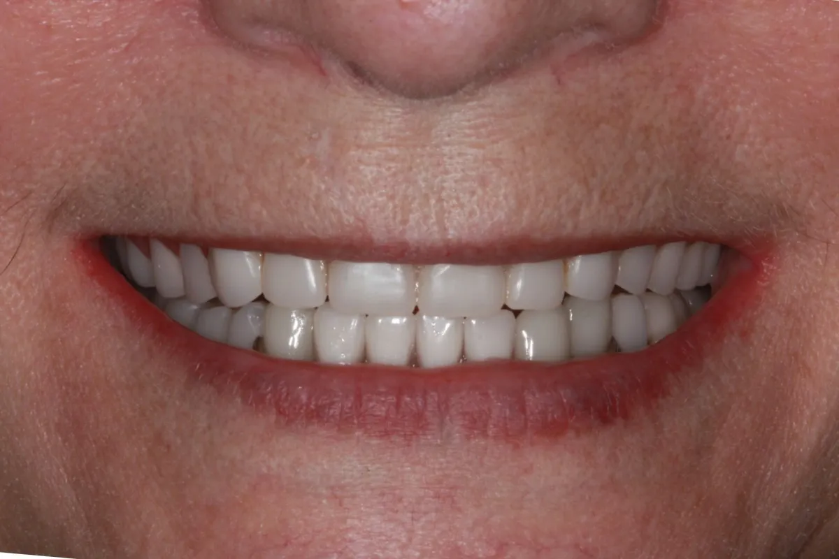Dentures-partial at woodyard dental care llc in paducah ky