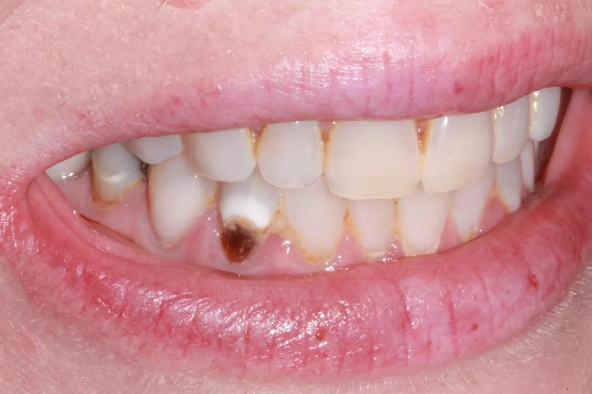 Dentures crown at woodyard dental care llc in paducah ky