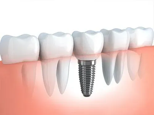 How a dental implant works