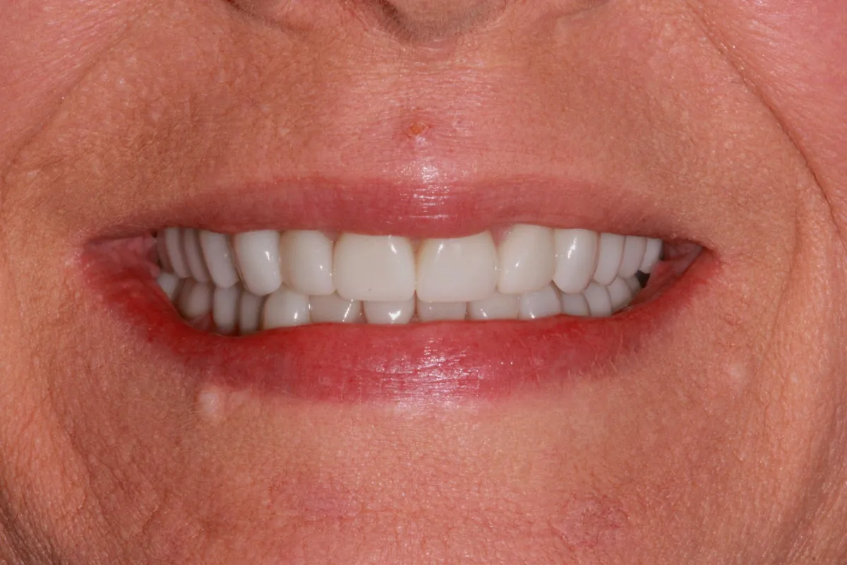 After teeth whitening treatment at Woodyard Dental Care LLC Paducah Ky
