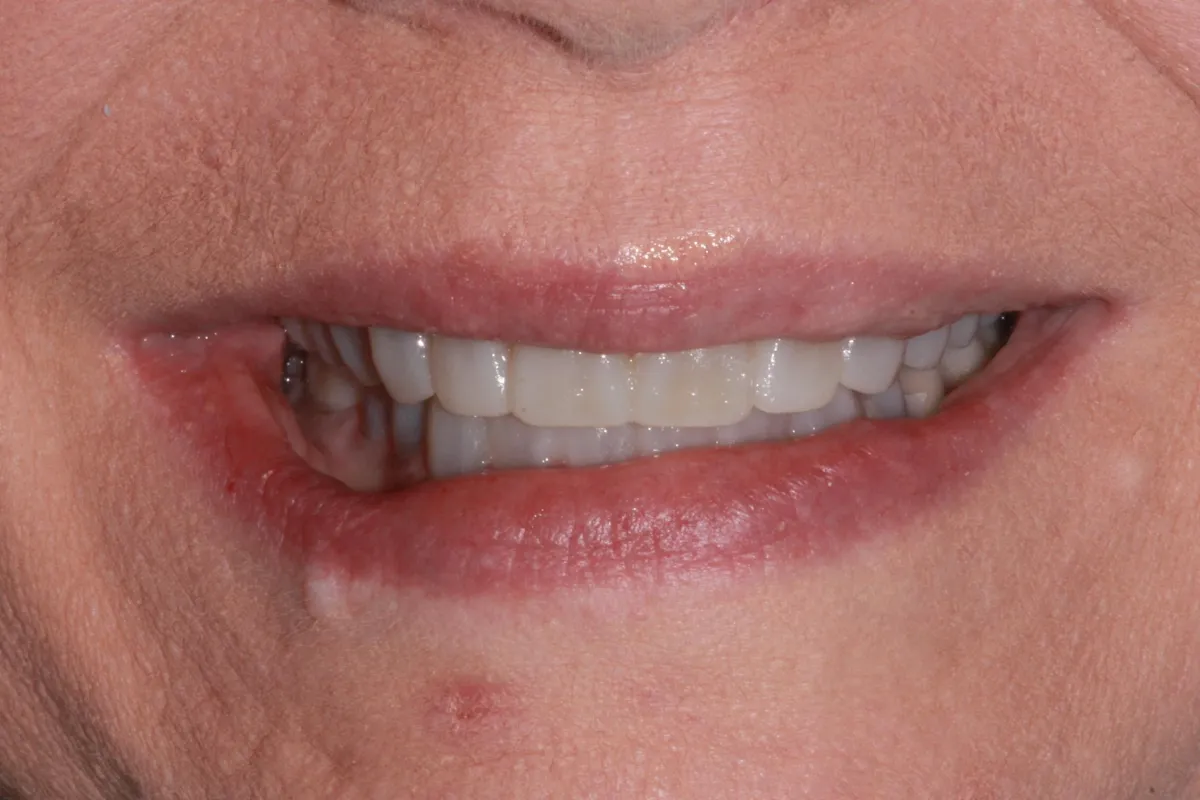 Before teeth whitening treatment at Woodyard Dental Care LLC Paducah Ky