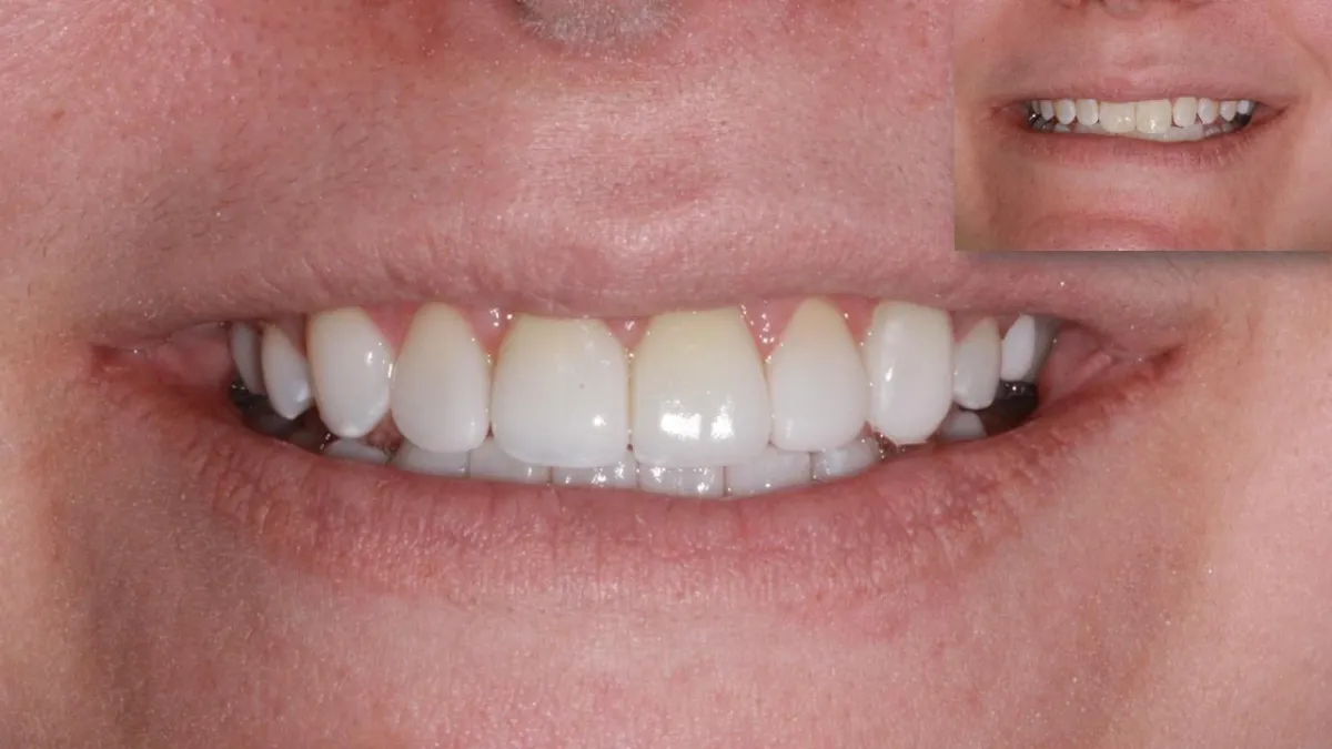 Cosmetic Dentistry, Teeth Whitening, Bonding, Veneers