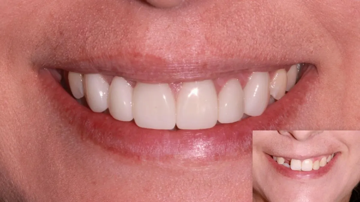 Dental restorative procedure