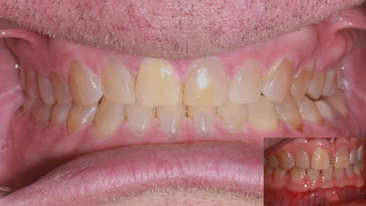 Clear Aligners to help straighten teeth, cosmetic dentistry Paducah Ky
