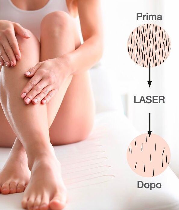 epilazione laser
