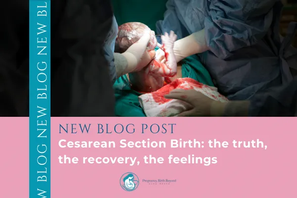 Cesarean Birth: a midwife's perspective