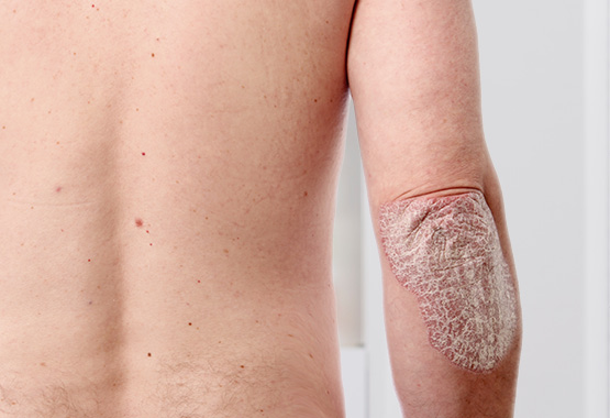 Todo sobre psoriasis