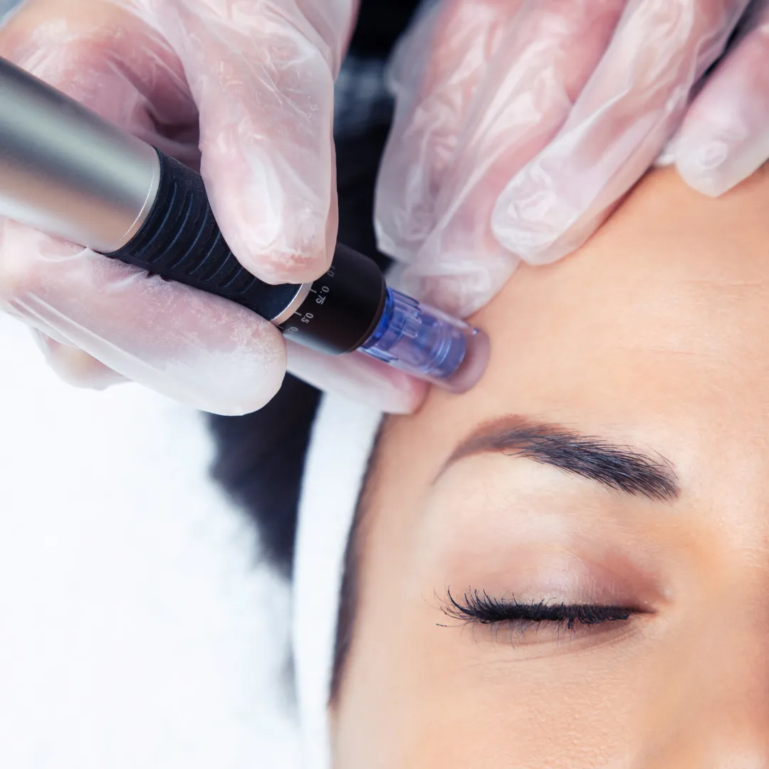 Microneedling in