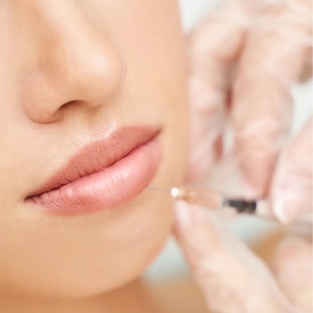 Lip Filler in
