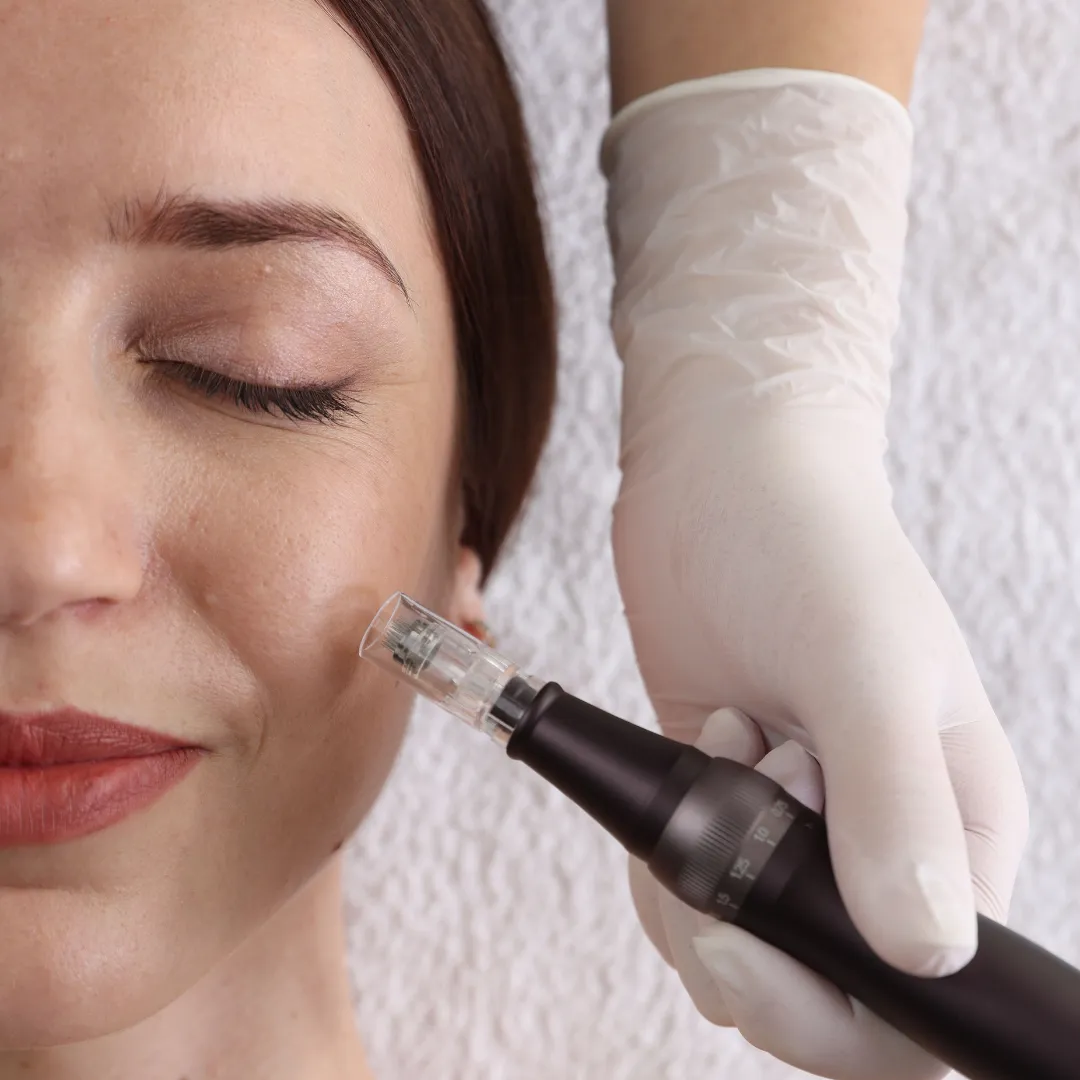 Microneedling procedure at Skin Glow Aesthetics in Webster Groves, MO