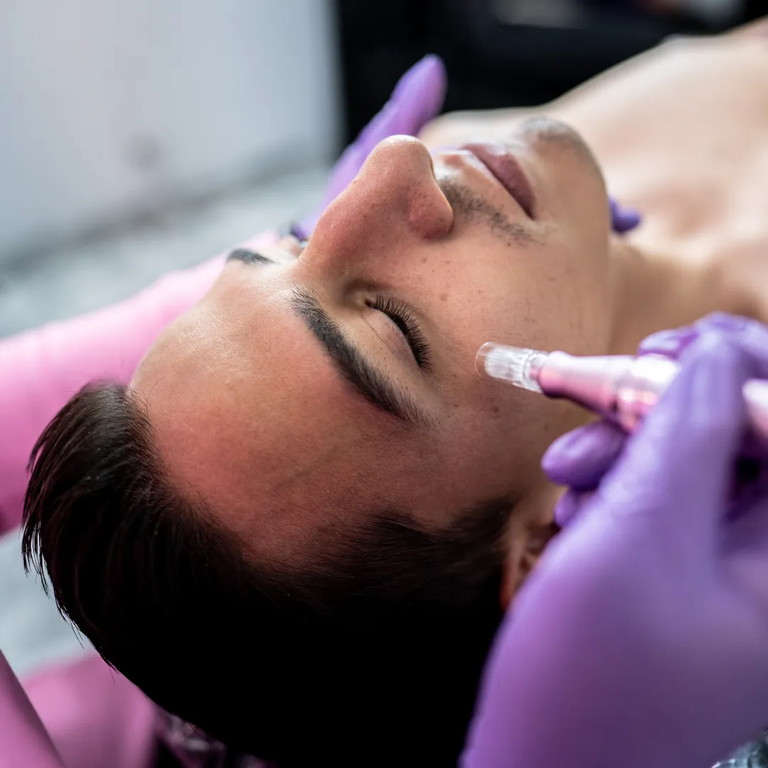Microneedling procedure at Skin Glow Aesthetics in Webster Groves, MO