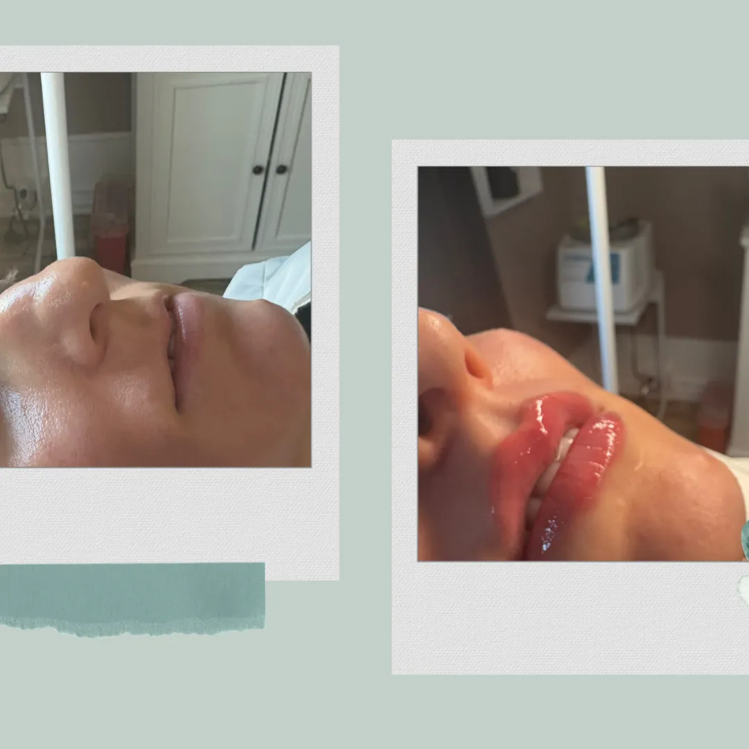 Lip Filler in Webster Groves, MO
