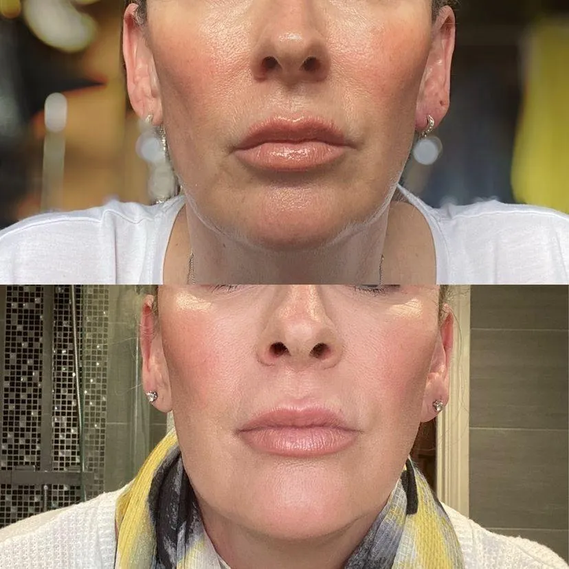 Morpheus8 before and after
