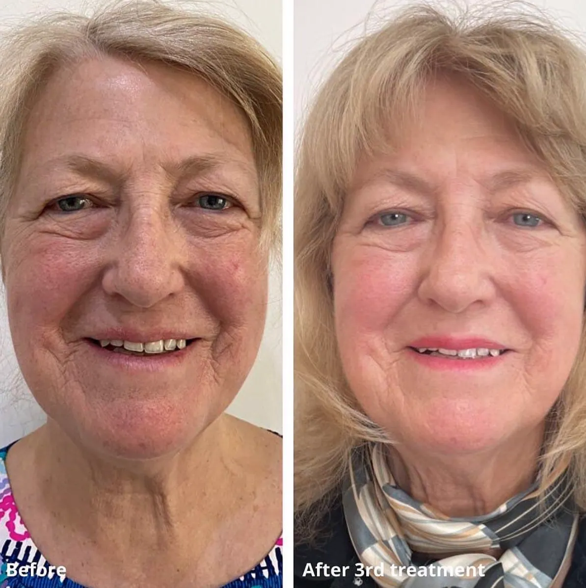 morpheus face treatment before and after