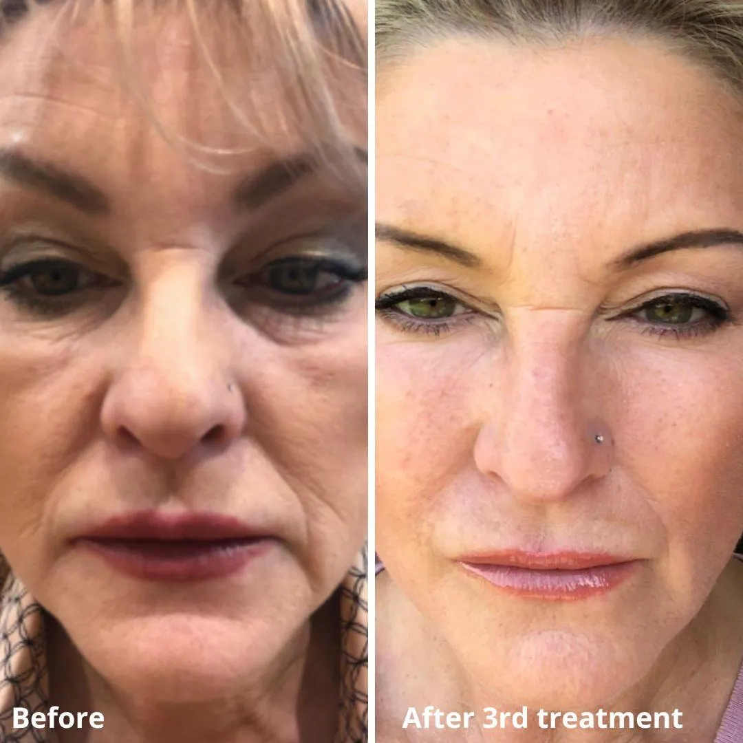 morpheus8 treatment near me before and after