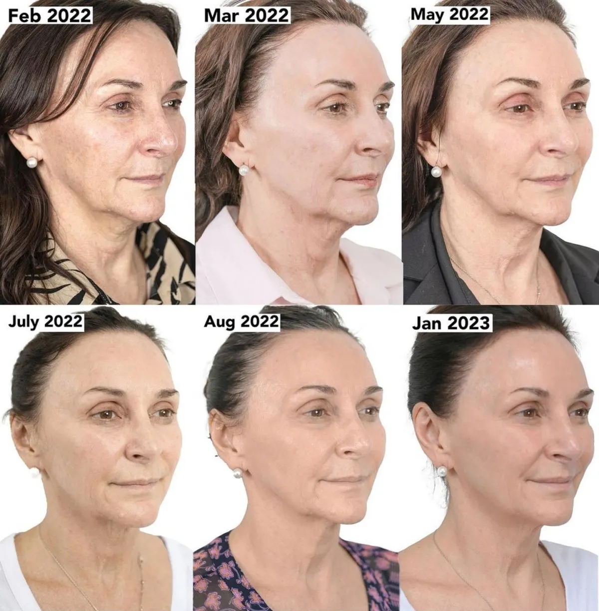 Shirley Ballas before and after