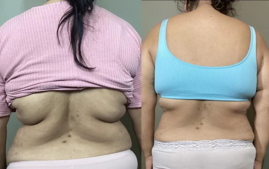 Lymphatic drainage in Edmond, OK with gentle tools