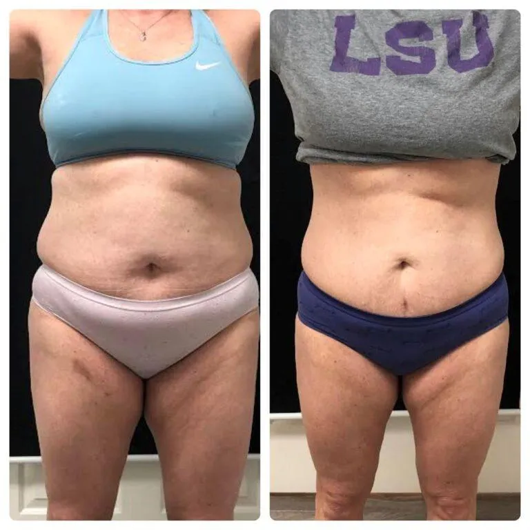 Lymphatic drainage in Edmond, OK with gentle tools
