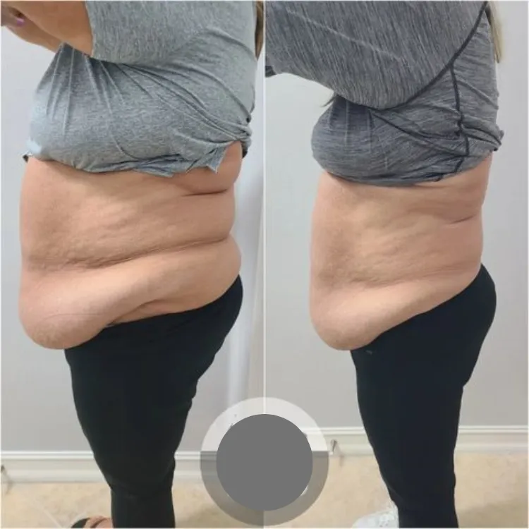 Lymphatic drainage in Edmond, OK with gentle tools