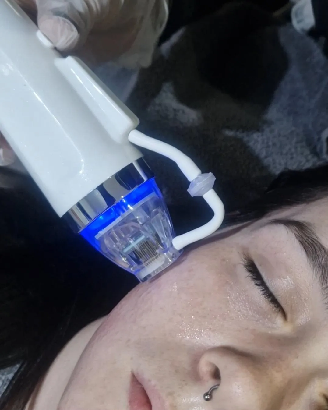 RF Fractional Mcro-Needling