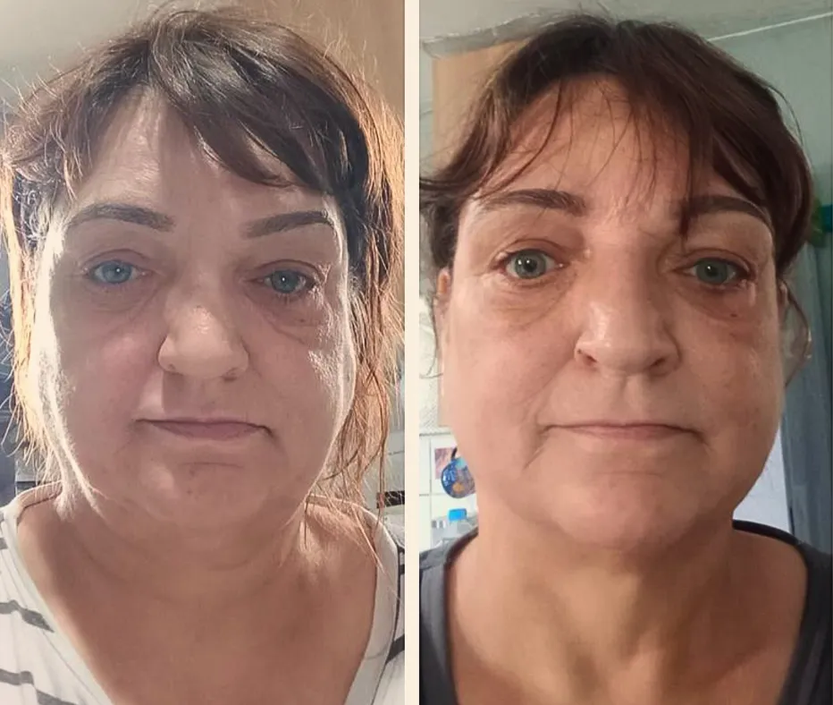 HIFU Face Lifts