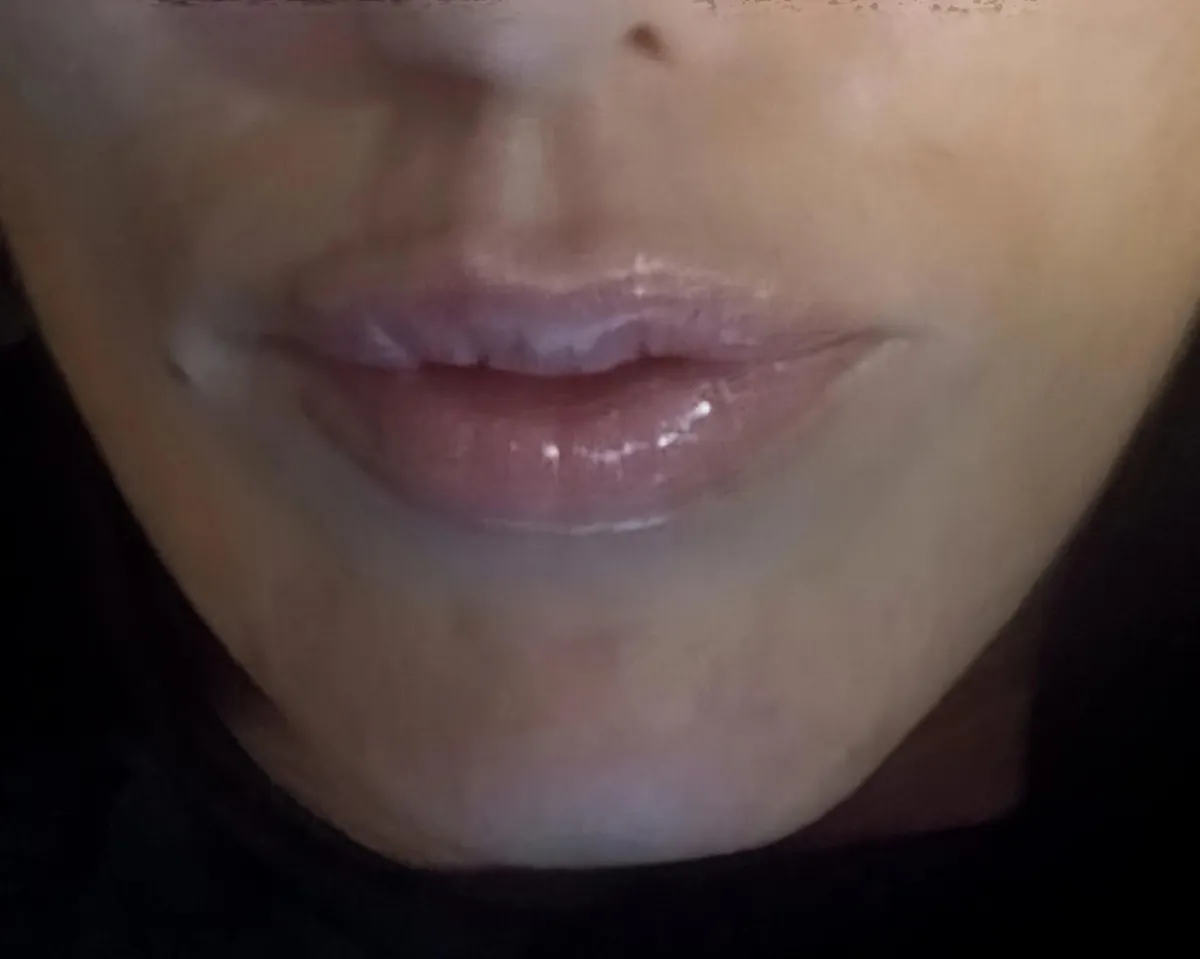Dermal Fillers, Lip Filler