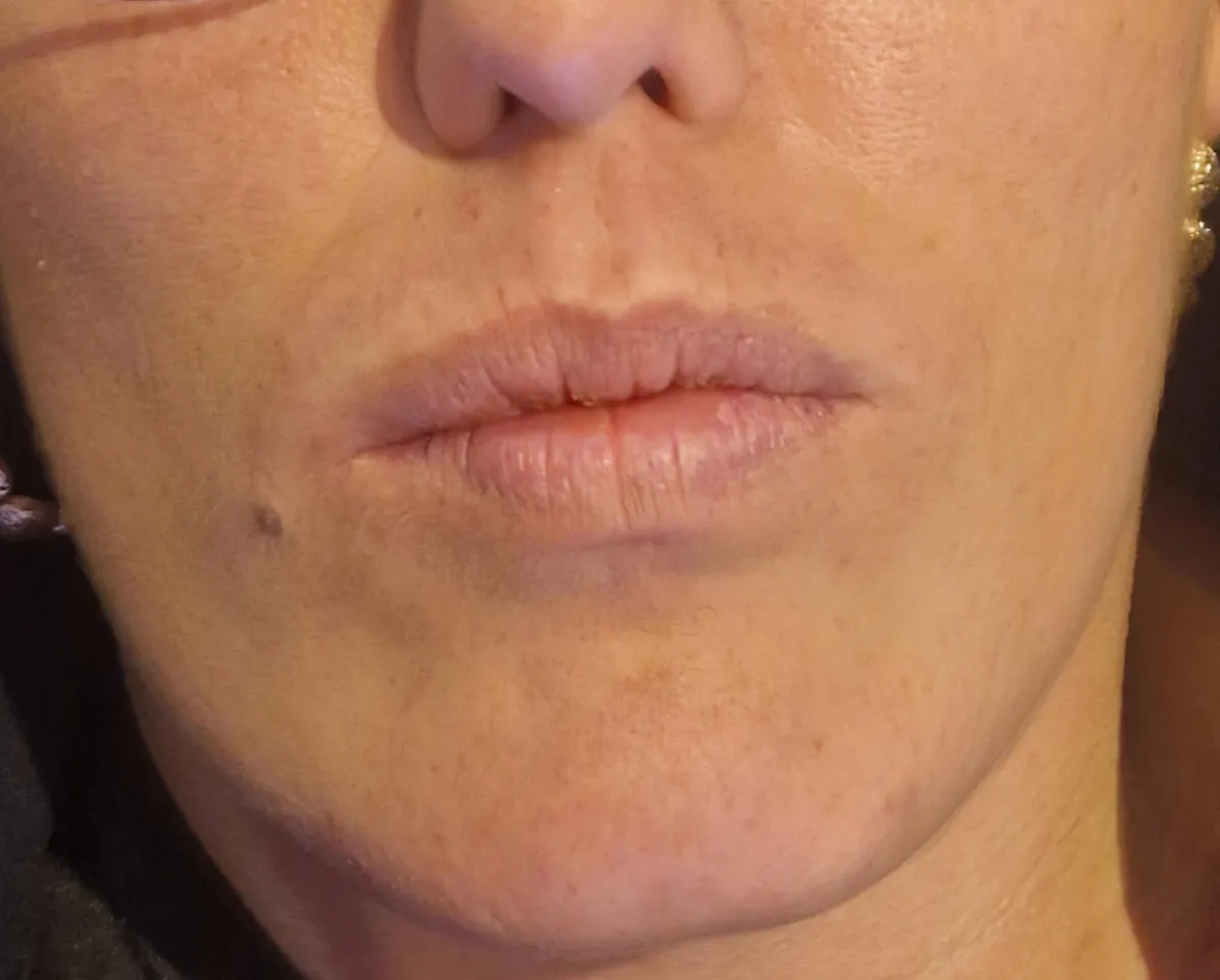 Dermal Fillers Li iller