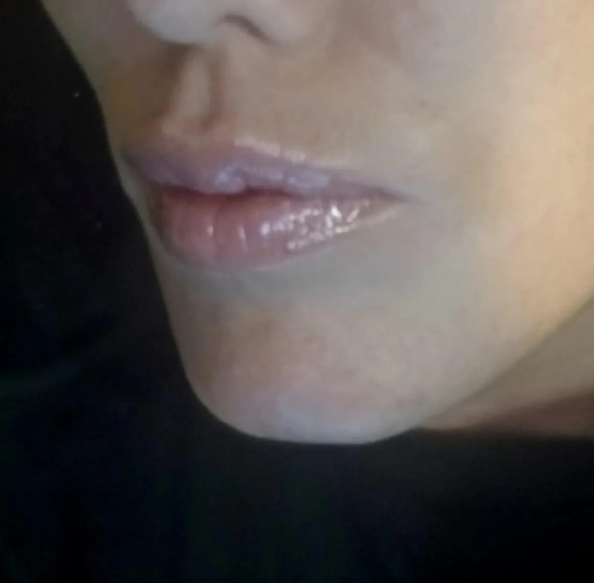 Dermal Fillers, Lip Filler, Face Filler