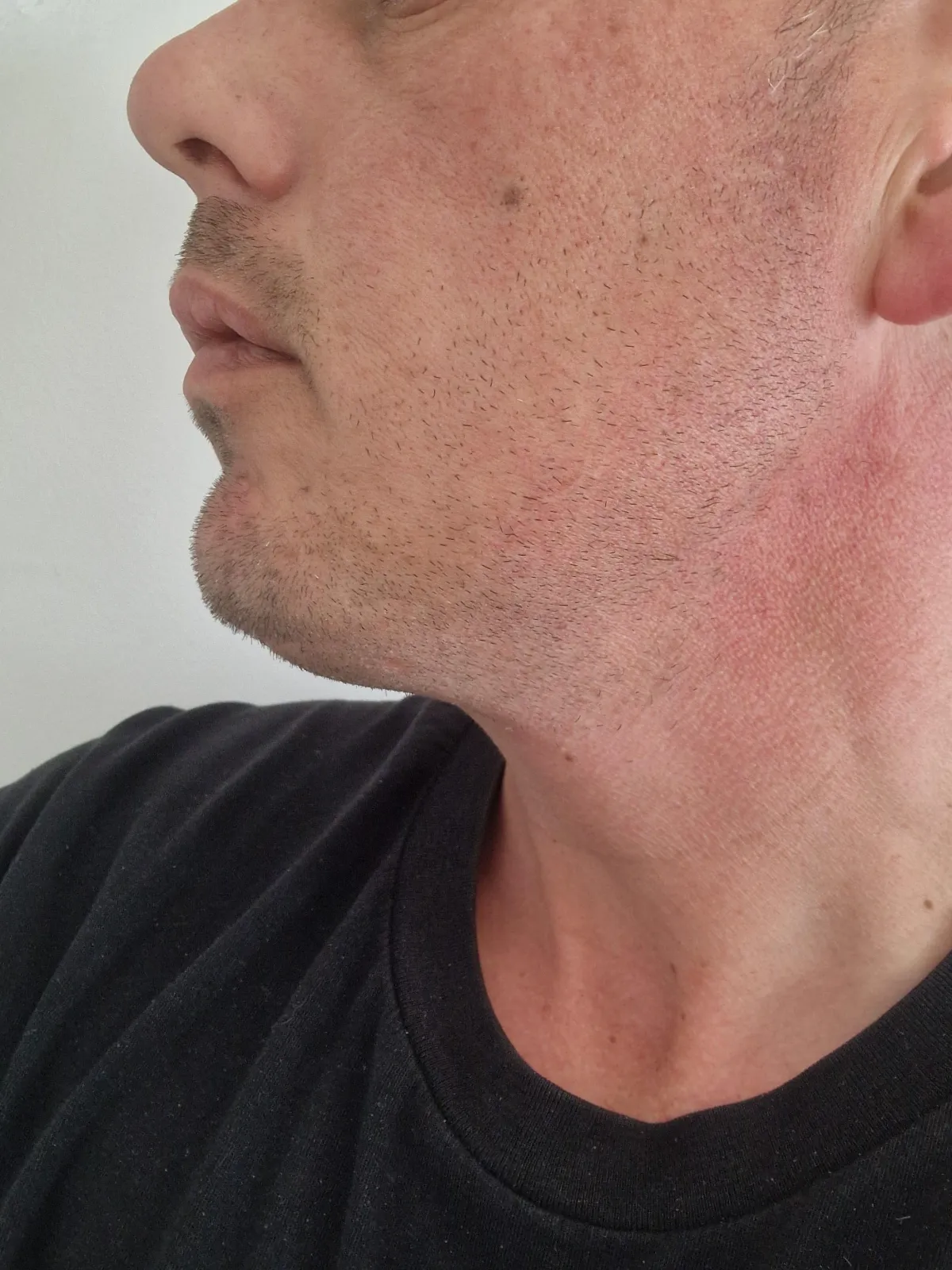 Dermal Fillers, Lip Filler, Face Filler