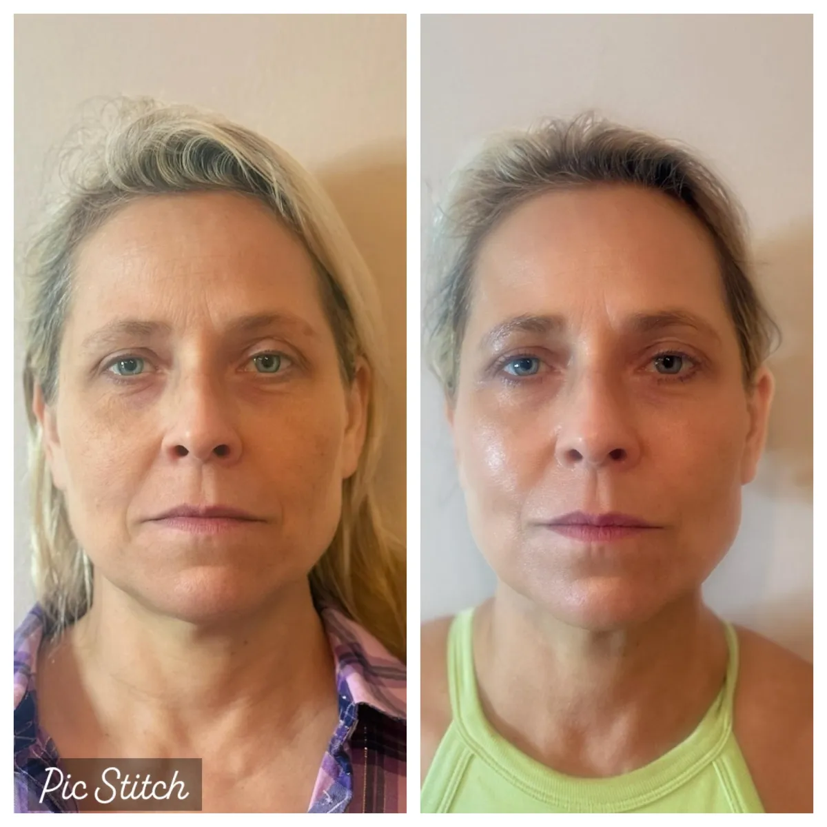 Before and after NeoGen PSR treatment showing a woman’s facial rejuvenation results at Soul Serenity Beauty & Wellness.