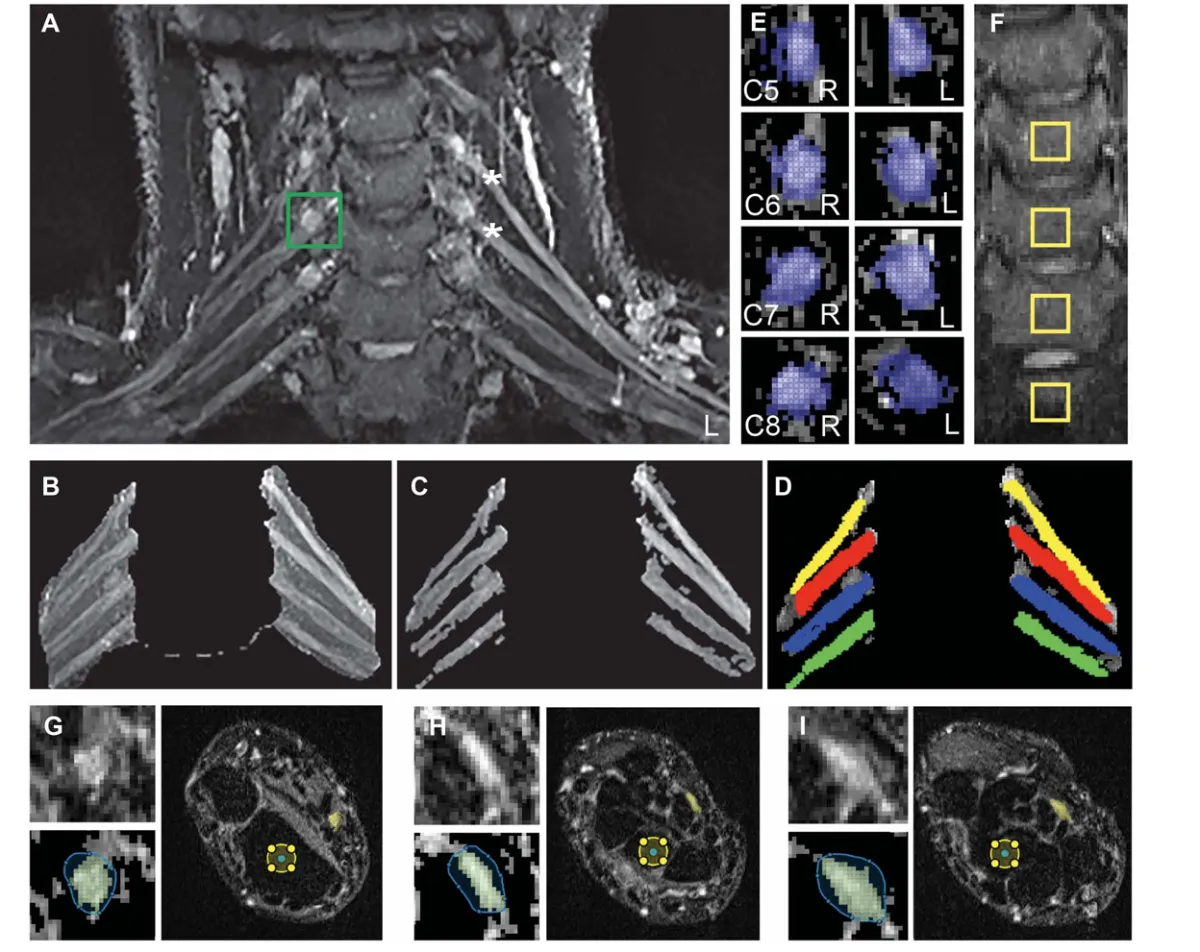 Whiplash, Neuroinflammation, and Neural Edema: Why Sports Medicine Is Finally Catching Up