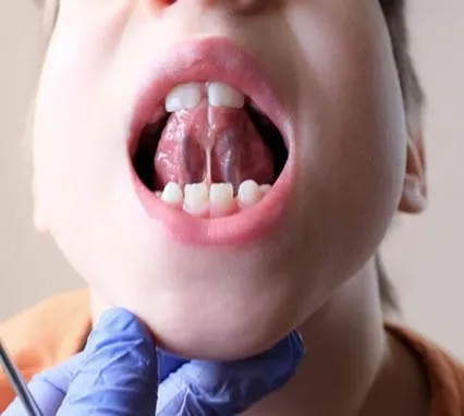 Tongue-Tie Prevention & Re-Education