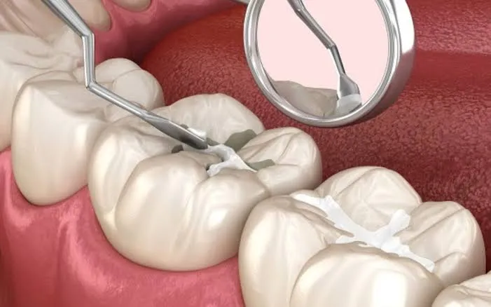 Dental sealant being applied to a child's molar to help prevent cavities